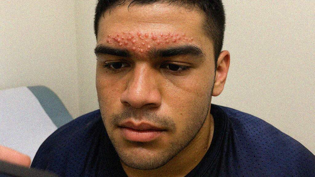 Forehead Pustules from Football Helmet Strap | Acne mechanica | DermRounds