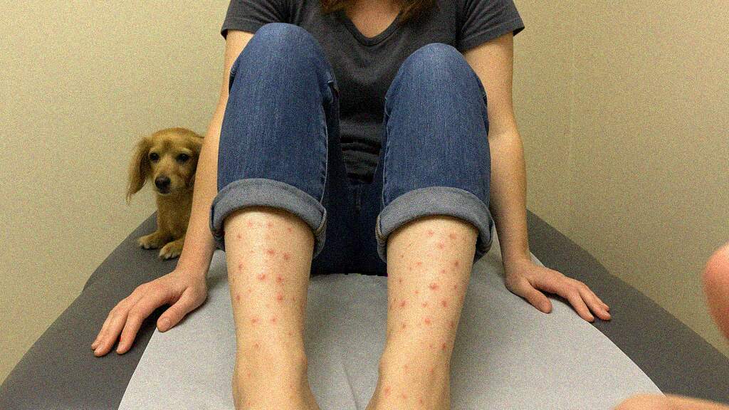 Crops of Itchy Pink Papules Around the Ankles in a Pet Owner | Flea ...